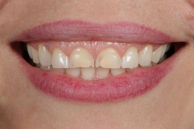 Full Mouth Rehabilitation: Jessica - Before