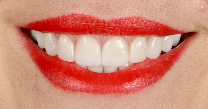 Full Mouth Rehabilitation: Jessica - After