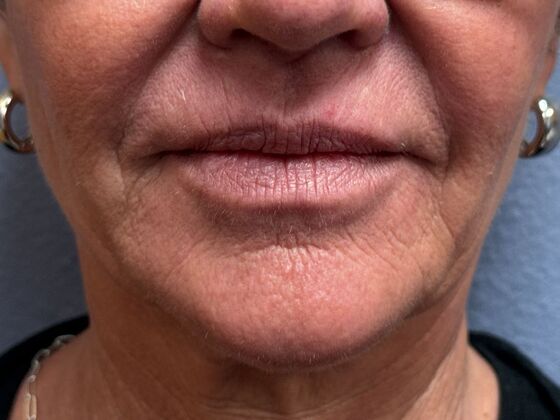 Cosmetic Injectables & Fillers*: Case 61 - Before