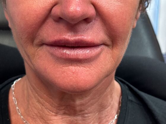 Cosmetic Injectables & Fillers*: Case 61 - After