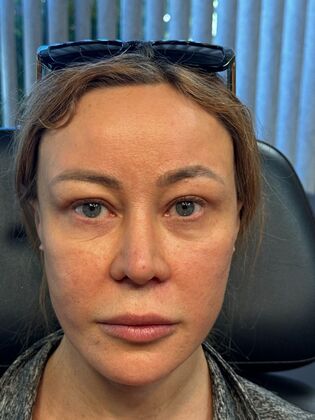 Cosmetic Injectables & Fillers*: Case 62 - After