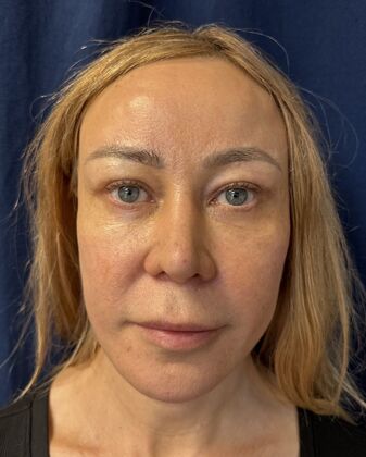 Cosmetic Injectables & Fillers*: Case 62 - Before