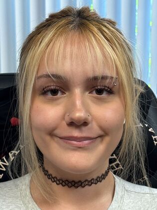 Cosmetic Injectables & Fillers*: Case 63 - Before