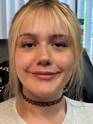 Cosmetic Injectables & Fillers*: Case 63 - After