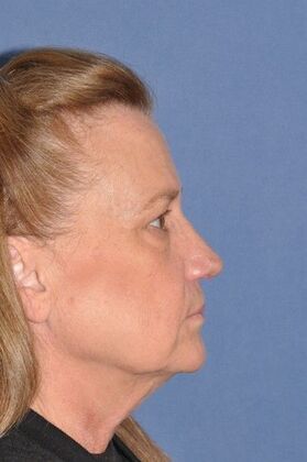 Facelift: Deep Plane Face and Neck, Endo Brow Lower Lids - Before
