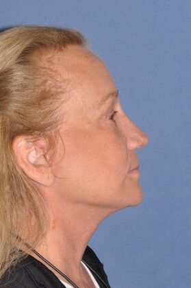 Facelift: Deep Plane Face and Neck, Endo Brow Lower Lids - After