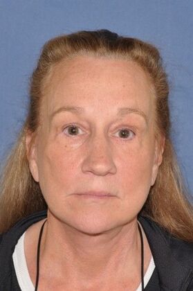 Facelift: Deep Plane Face and Neck, Endo Brow Lower Lids - After