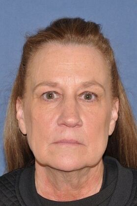 Facelift: Deep Plane Face and Neck, Endo Brow Lower Lids - Before
