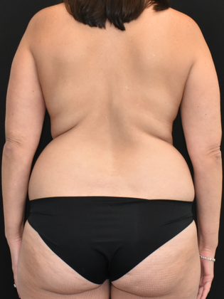 Mommy Makeover: Case 15 - Before