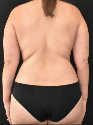 Mommy Makeover: Case 15 - After