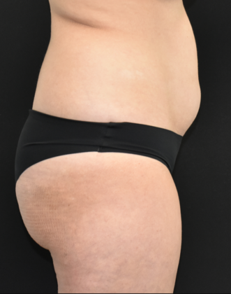 Abdominoplasty: Case 29 - Before