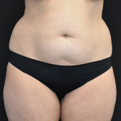 Abdominoplasty Case 29 - Before