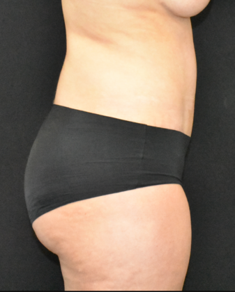 Abdominoplasty: Case 29 - After