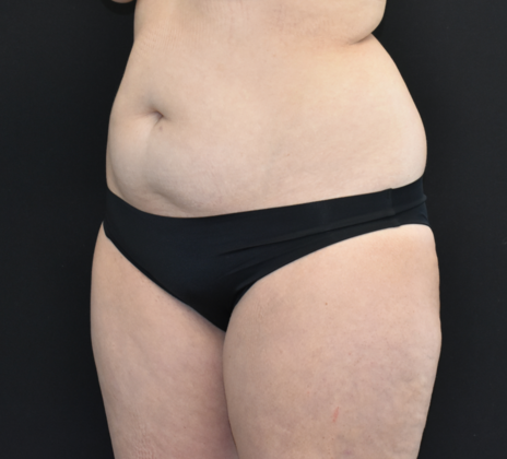 Abdominoplasty: Case 29 - Before