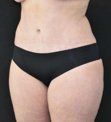 Abdominoplasty: Case 29 - After