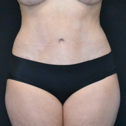 Abdominoplasty Case 29 - After