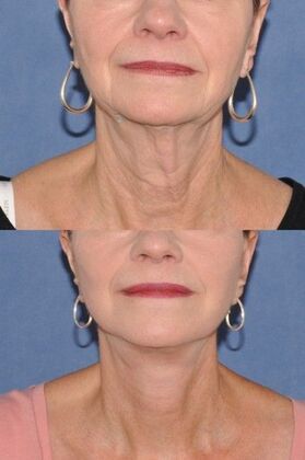 Facelift: Deep plane facelift and necklift - Before and after