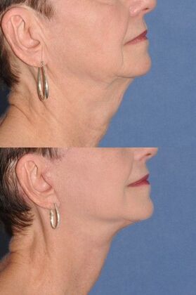 Facelift: Deep plane facelift and necklift - Before and after