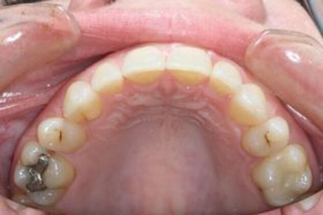 Invisalign: Case 1 - After upper