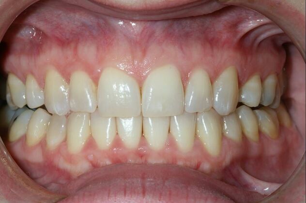Invisalign Case 1 - After
