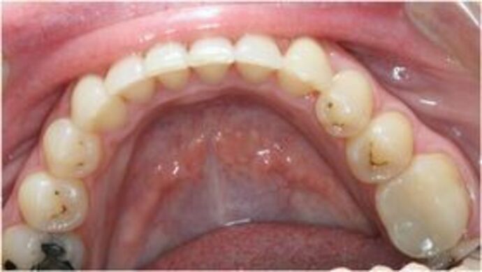 Invisalign: Case 1 - After lower 