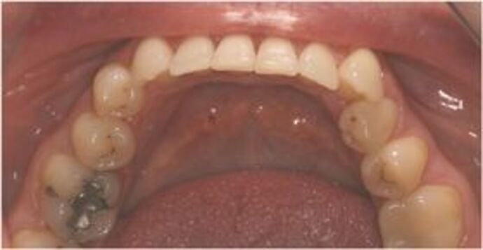 Invisalign: Case 1 - Before lower 