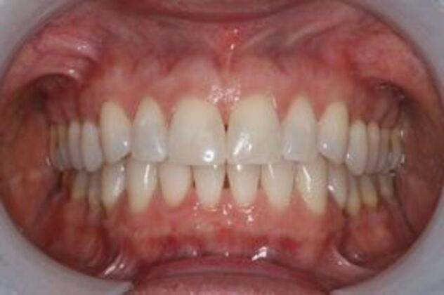Invisalign Case 2 - After