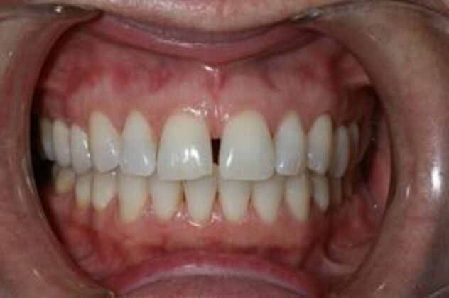 Invisalign Case 2 - Before