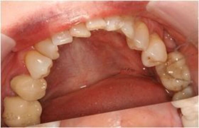 Invisalign: Case 3 - Before lower