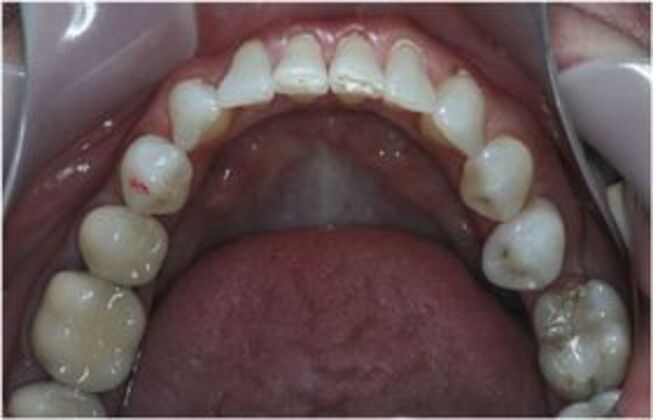 Invisalign: Case 3 - After lower