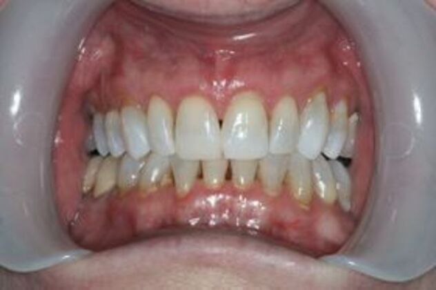 Invisalign Case 3 - After