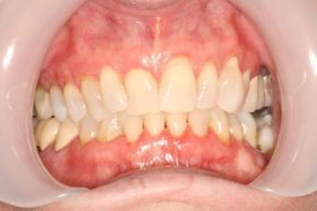 Invisalign Case 3 - Before