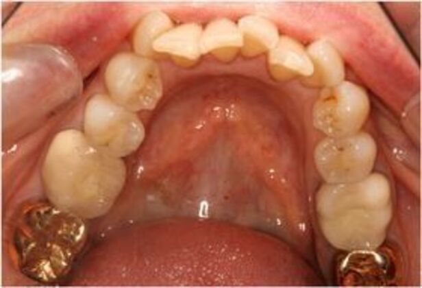 Invisalign: Case 4 - Before