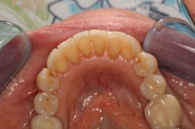 Invisalign: Case 4 - After