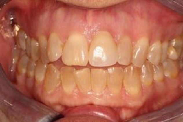 Cerec: Case 1 - Cerec Crown on a Single Front Tooth - After