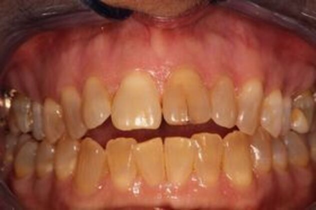 Cerec: Case 1 - Cerec Crown on a Single Front Tooth - Before