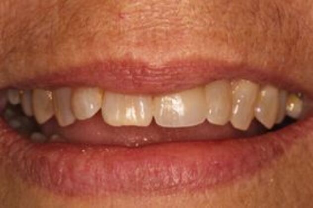 Cerec Case 1 - Cerec Crown on a Single Front Tooth - After
