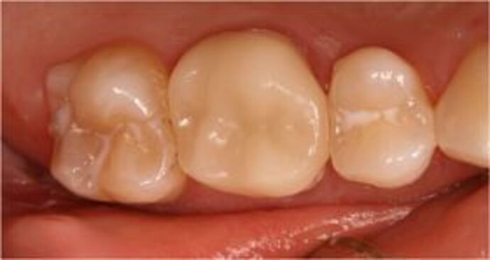 Cerec Case 2 - Amalgam replacement with Cerec technology - After