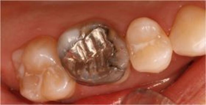 Cerec Case 2 - Amalgam replacement with Cerec technology - Before