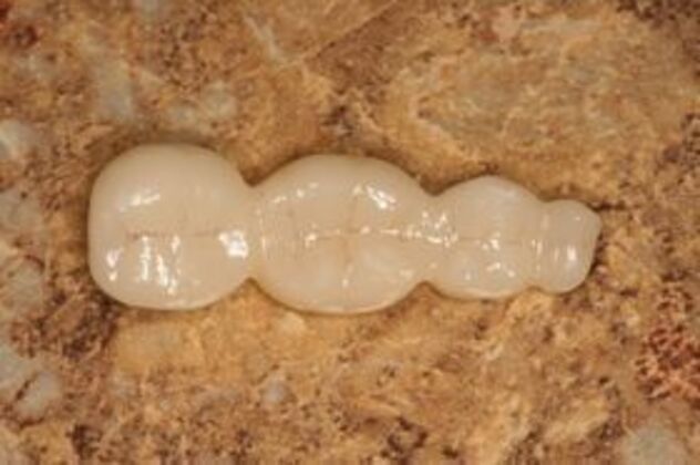 Cerec: Case 3 - EmaxCAD bridge - processed EmaxCAD bridge on benchtop