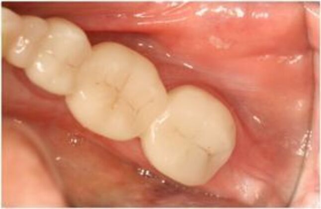Cerec Case 3 - EmaxCAD bridge - After