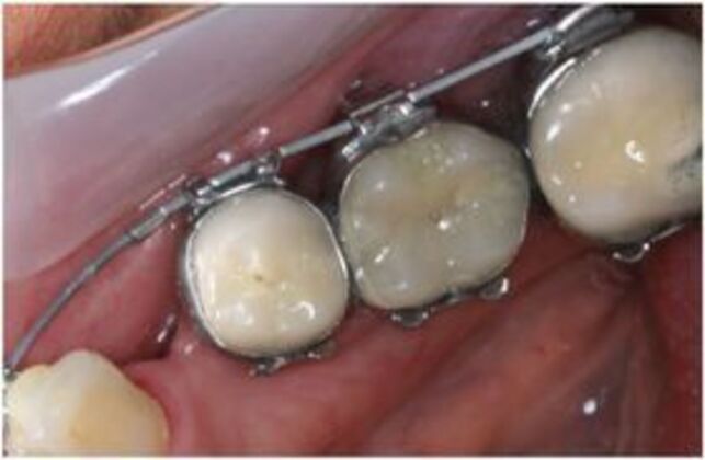 Cerec Case 3 - EmaxCAD bridge - Before
