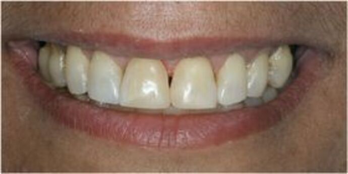 Composite Bonding Case 1 - After