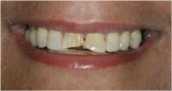 Composite Bonding Case 1 - Before