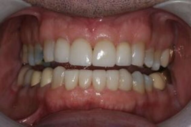 Porcelain Veneers: Case 1 - After