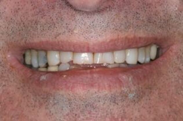 Porcelain Veneers: Case 1 - Before