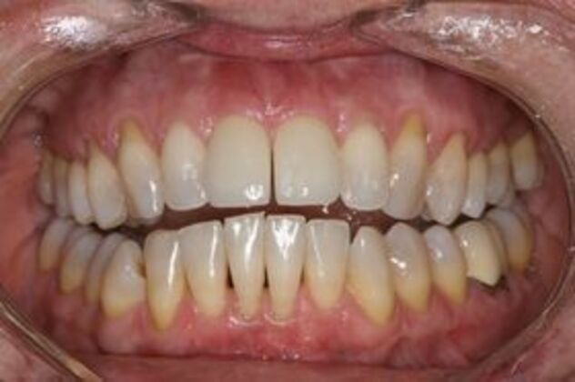 Dental Implants: Case 1 - After