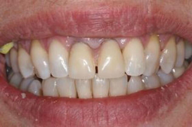 Dental Implants: Case 1 - Interim treament removable partial denture