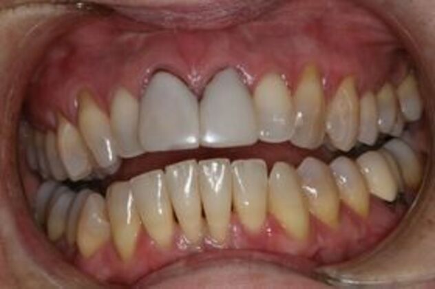 Dental Implants: Case 1 - Before