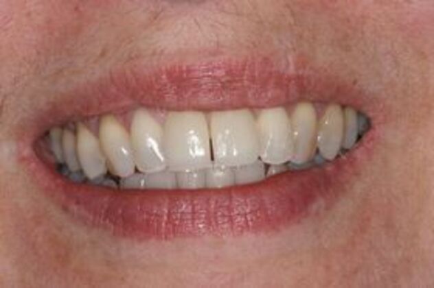 Dental Implants: Case 1 - After